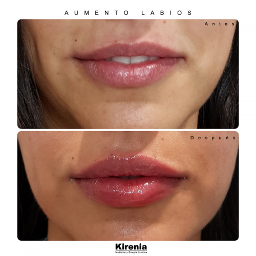 Relleno de labios